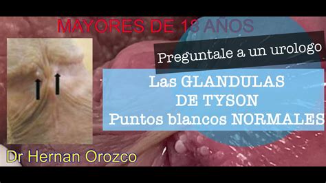 que son las glandulas de tyson|Pápulas perladas